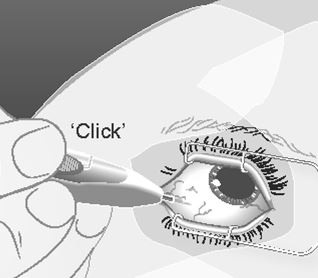 Ozurdex intravitreal implantat i applikator 700 mikrogram AbbVie Deutschland GmbH &amp; Co. KG