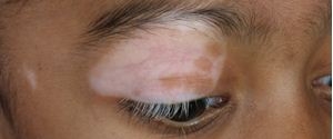 Vitiligo