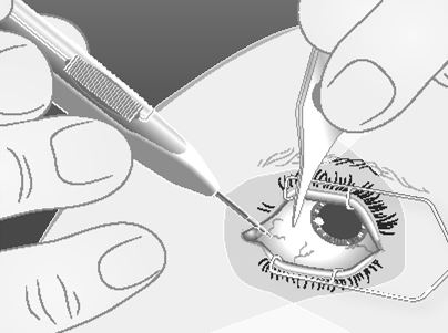 Ozurdex intravitreal implantat i applikator 700 mikrogram AbbVie Deutschland GmbH &amp; Co. KG