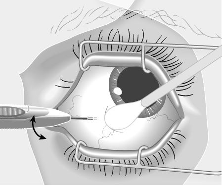 Ozurdex intravitreal implantat i applikator 700 mikrogram AbbVie Deutschland GmbH &amp; Co. KG