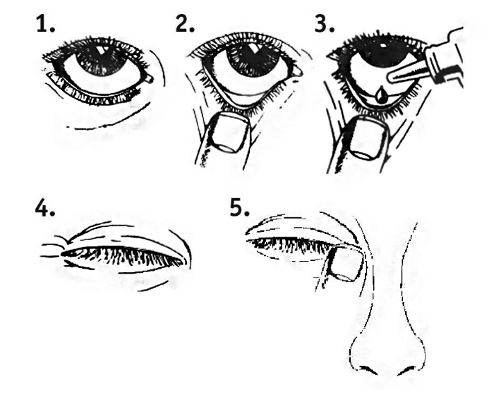 Ganfort® øjendråber, opløsning 0,3+5 mg/ml 2care4 ApS