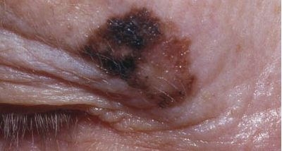 Modermærkekræft ved øjet