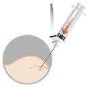 Triptorelin "Orifarm" Orifarm A/S depotinjektionsvæske, pulver og solvens til suspension 11,25 mg