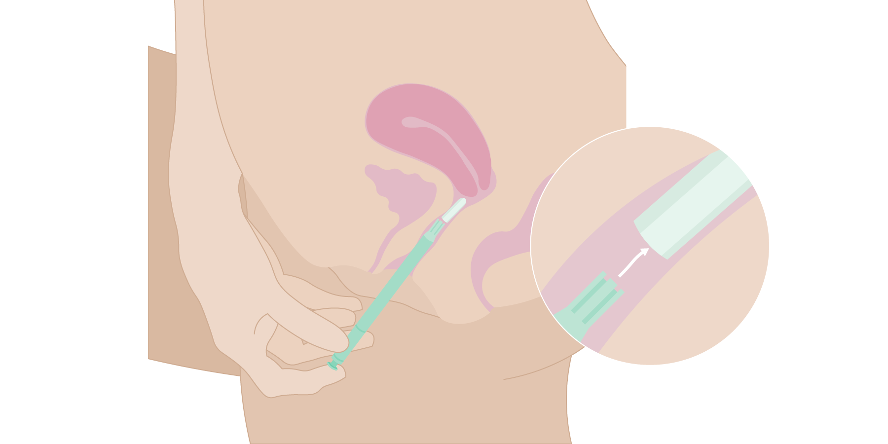 Medicin-som-bruges-i-skeden_applikator-vagitorie_v01_2025.02.14.png