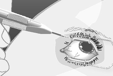 Ozurdex intravitreal implantat i applikator 700 mikrogram AbbVie Deutschland GmbH &amp; Co. KG