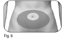 Gonal-f® injektionsvæske, opløsning i fyldt pen 300 IE Medartuum AB